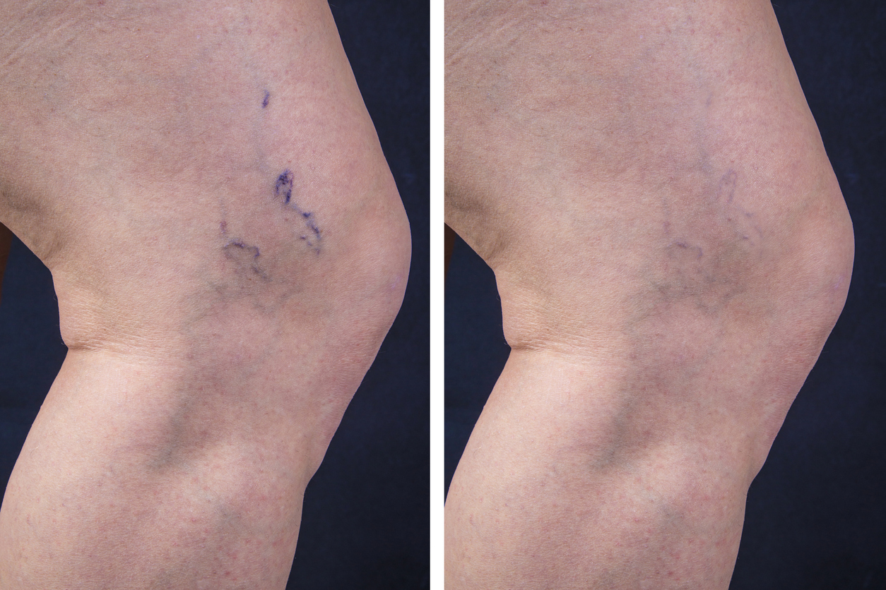 Before and after vein treatment